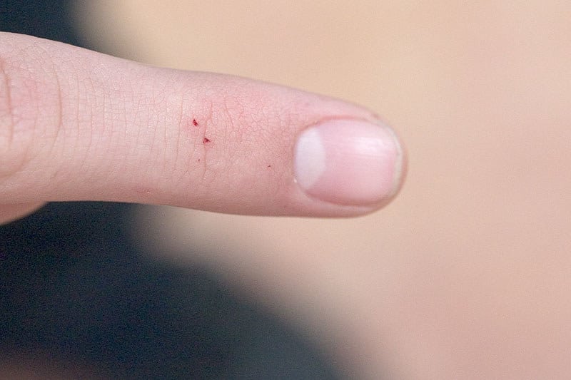 redback spider bite