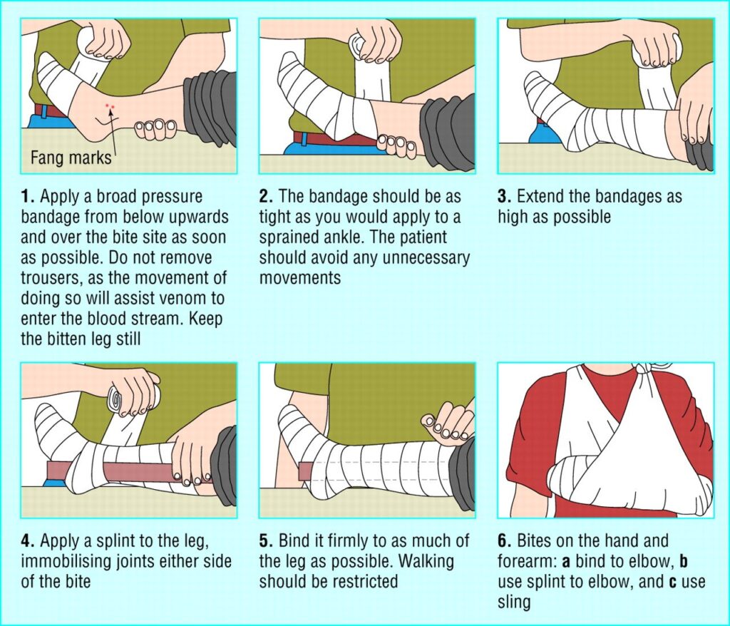Pressure+Immobilisation+Bandage