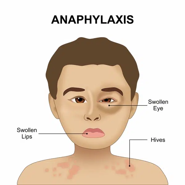 anaphylaxis first aid