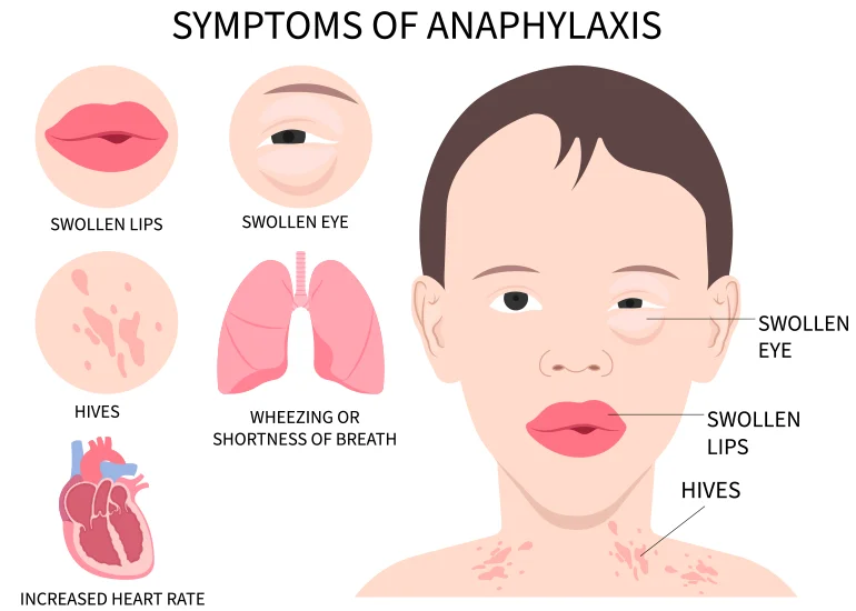 symptoms of severe allergic reaction