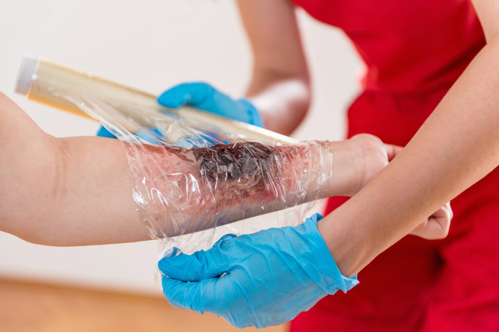 how to treat burns